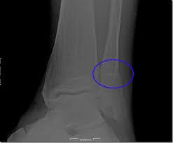 Runsupplies Blessuretips: Stressfracturen