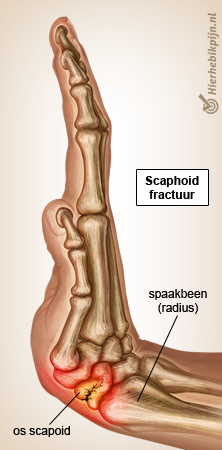 hand-scaphoid-fractuur