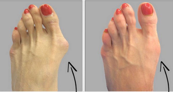 Mijn grote teen groeit scheef! Wat nu? - De Hallux Valgus