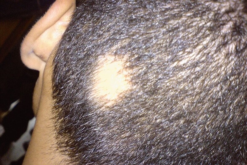 Man getroffen door alopecia areata