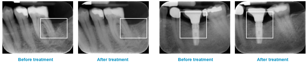 Bone growth