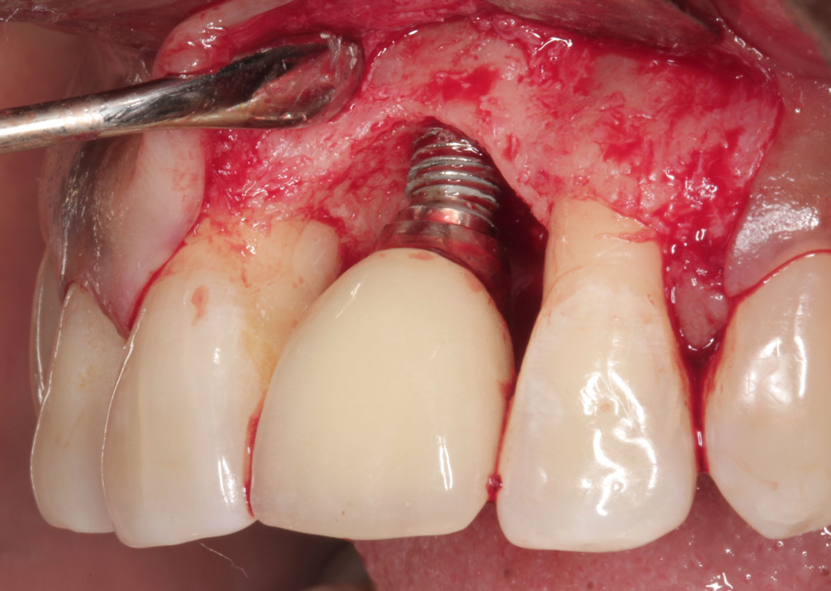 peri-implantitis