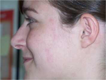 acne na toepassing Actimaris