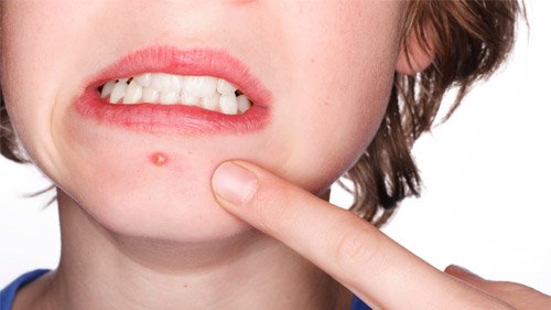 Die 10 besten Tipps gegen Pickel