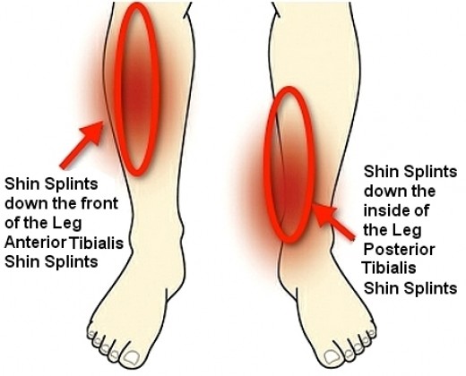 Inflamația în varigantul de shin, Inflamatia oaselor – Periostita - Periostul articulațiilor doare