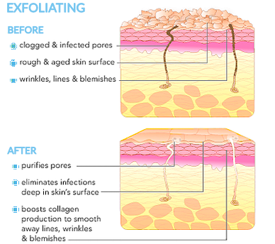 exfoliating