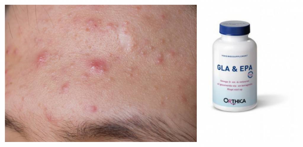 Acne en voedingssupplementen