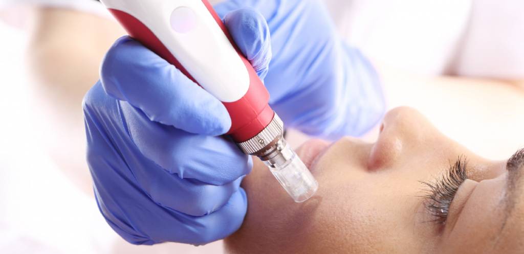 Microneedling tegen rimpels en littekens
