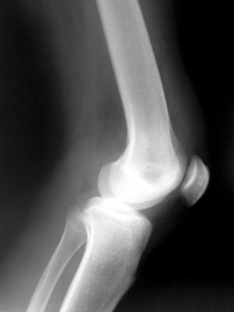 Hardloopblessure: De lopersknie