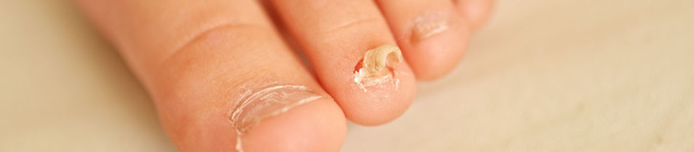 Athlete's foot and nail ringworm
