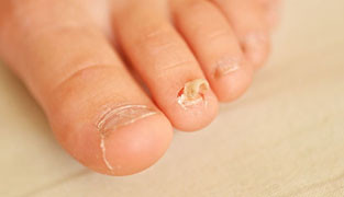 Athlete's foot & fungal nail