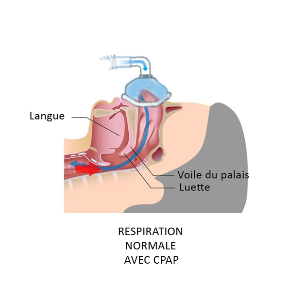 Schema-ronflement - Centre du ronflement et des troubles du sommeil