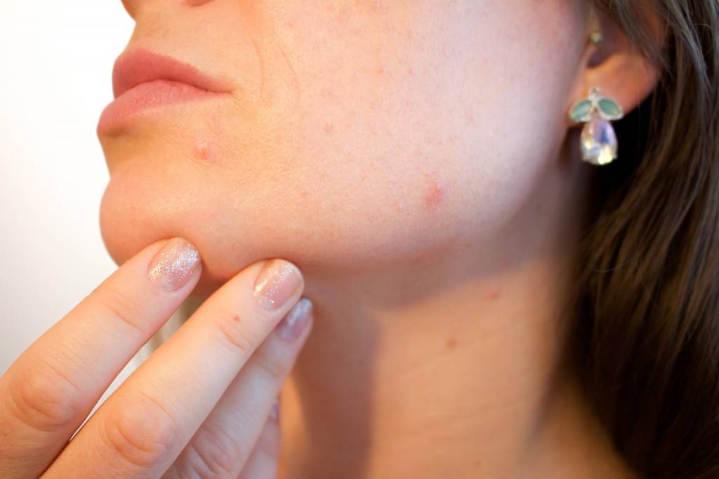 Acne - wat je wel en niet moet doen bij zo'n huid!